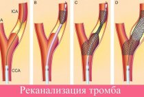 Caractéristiques de la mise en œuvre de la recanalisation du thrombus